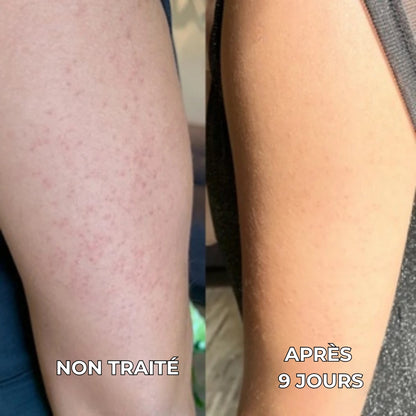 SOELIA™ - Strawberry | Le Soin Anti-Peau de Fraise